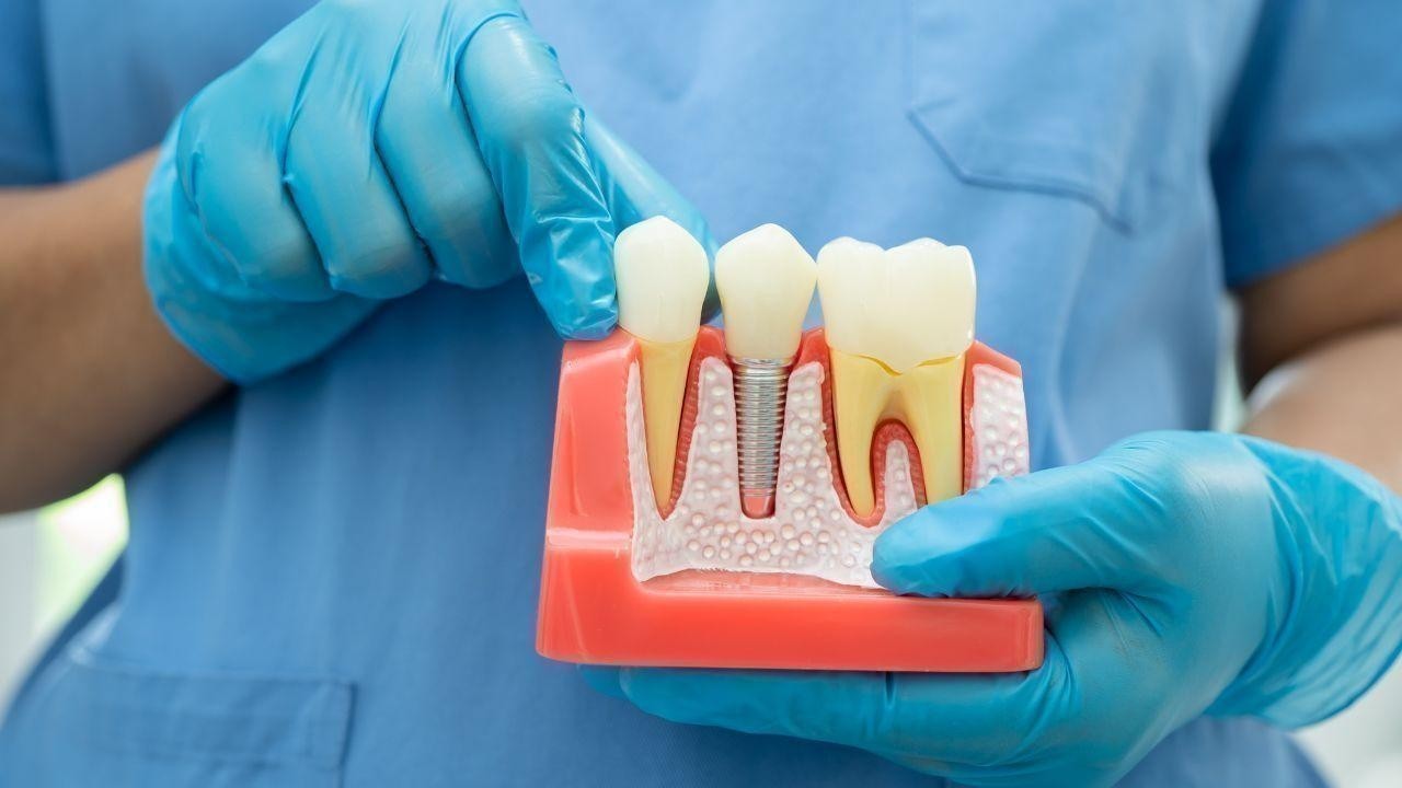 How Root Canal Treatment Can Relieve Pain and Save Your Smile