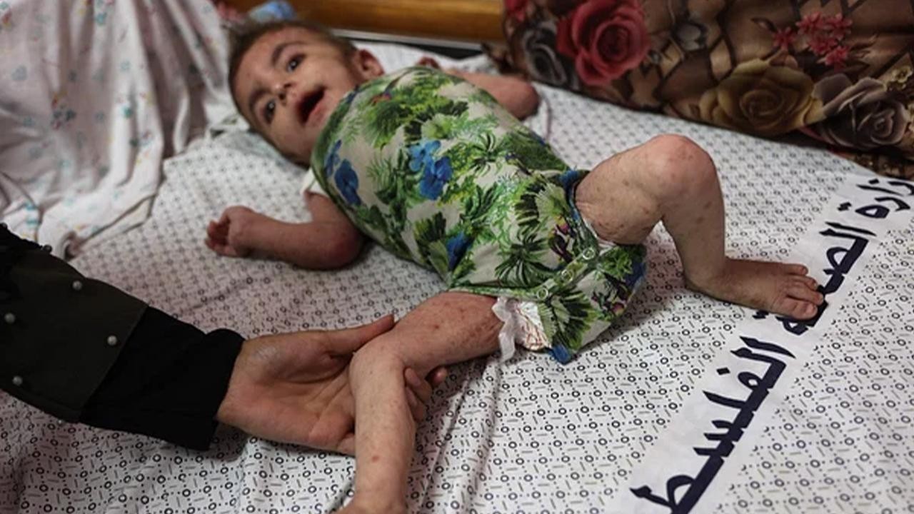 Alarming Spread of Dangerous Skin Diseases Among Malnourished Children in Gaza