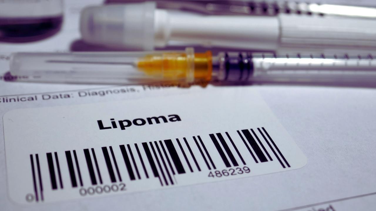 What Is a Lipoma? The Common Fatty Lump You Shouldn’t Ignore