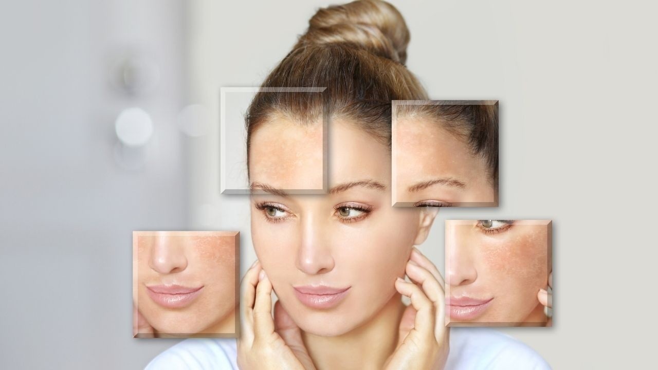 Effective Home Remedies to Reduce Pigmentation for Brides-to-Be