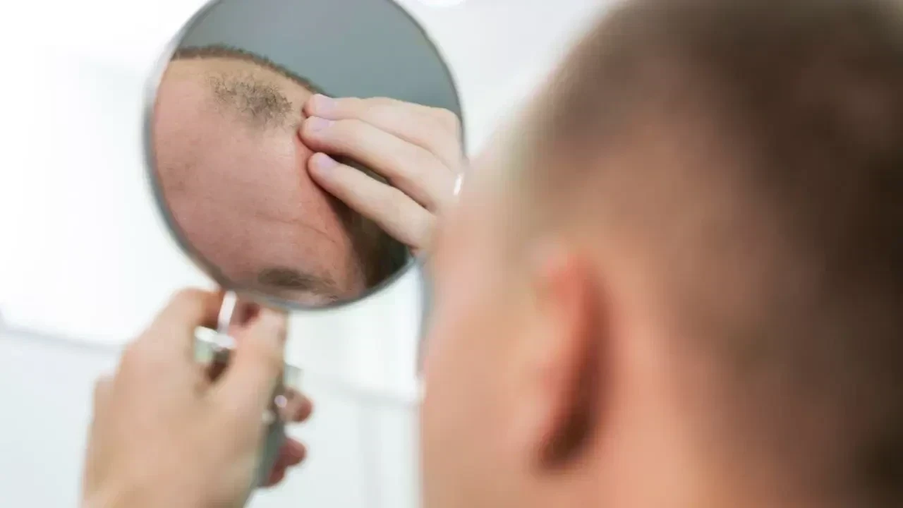 5 Miracle Oils That Can Actually Help Grow Hair on Bald Patches