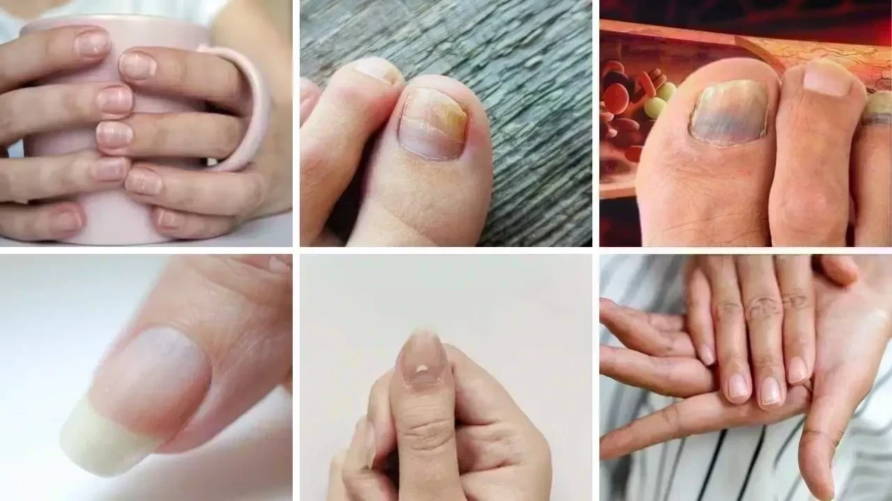 High Cholesterol Symptoms: 7 Nail Changes You Should Not Ignore