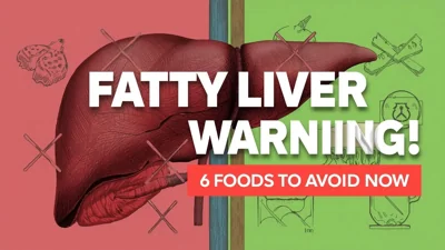 6 Foods Fatty Liver Patients Should Avoid for Better Liver Health